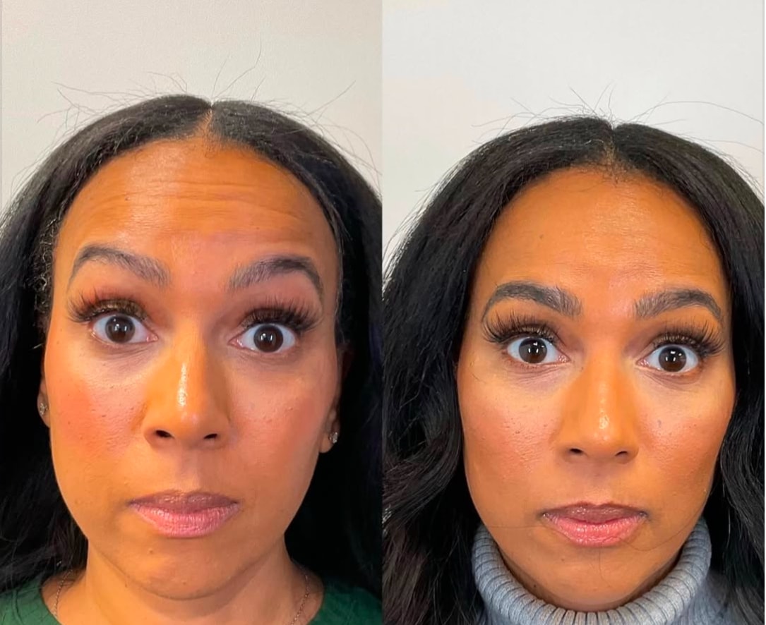 Botox forehead and brow lift before and after
