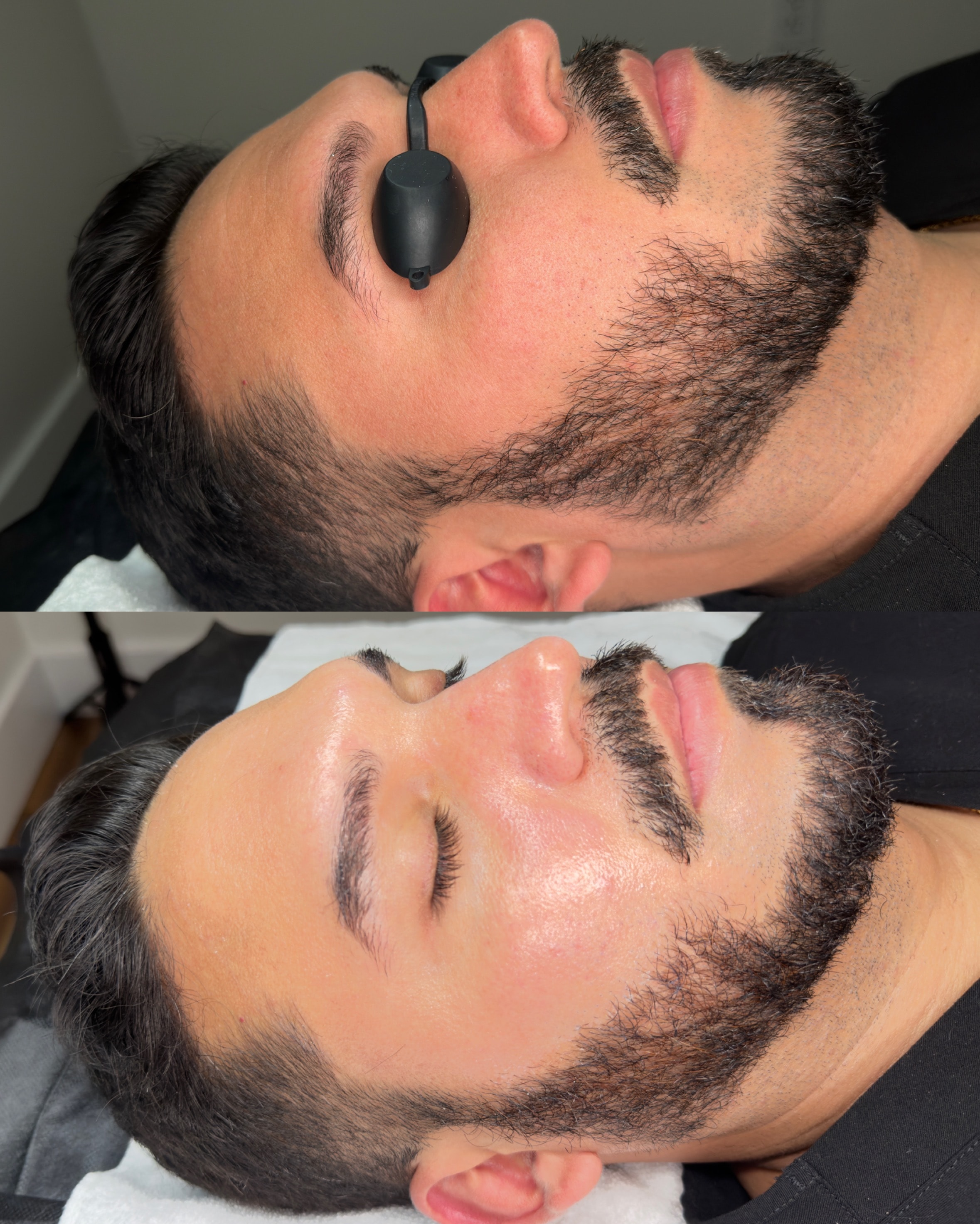 Microneedling before and after skin transformation