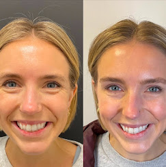 After — Natural Refresh