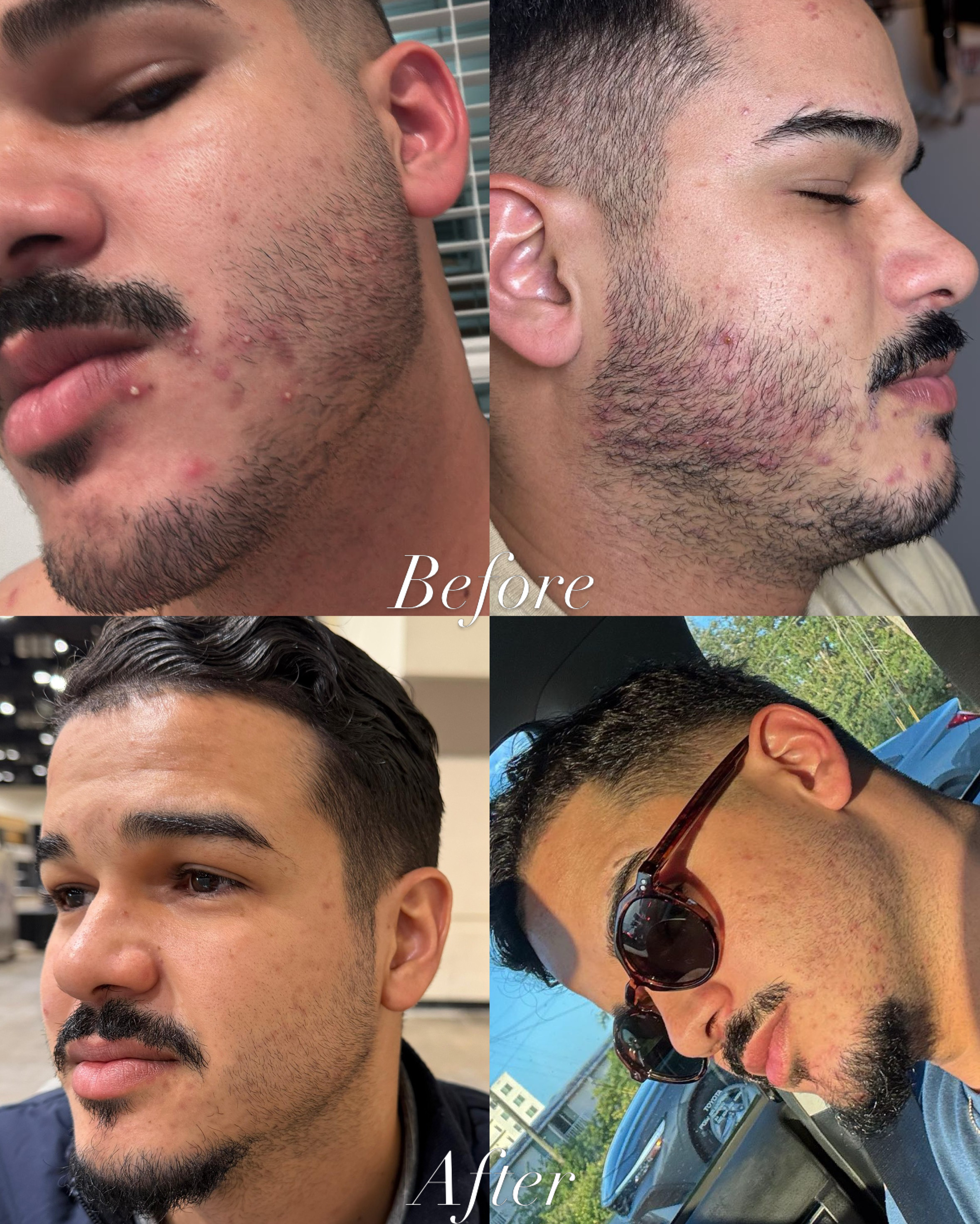 Male acne treatment before and after — Skin Care by Rejuvenate Wellness