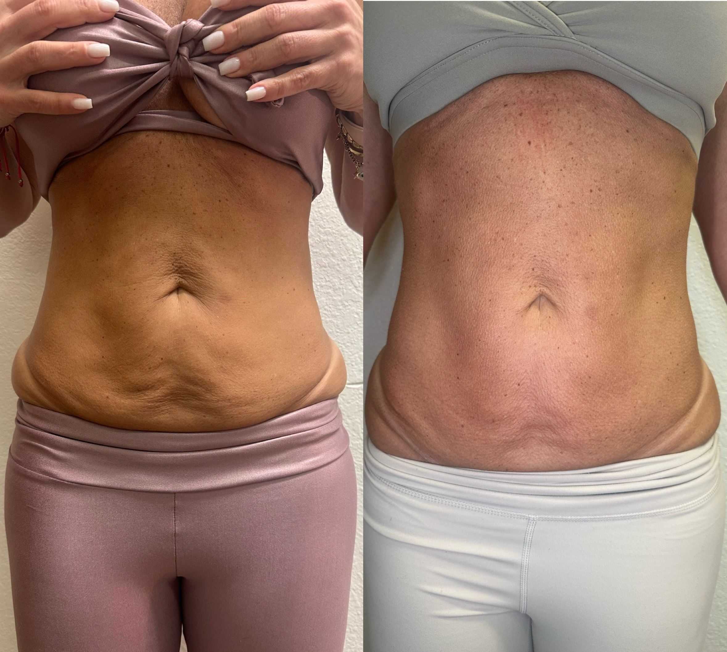 Female body contouring before and after — waist