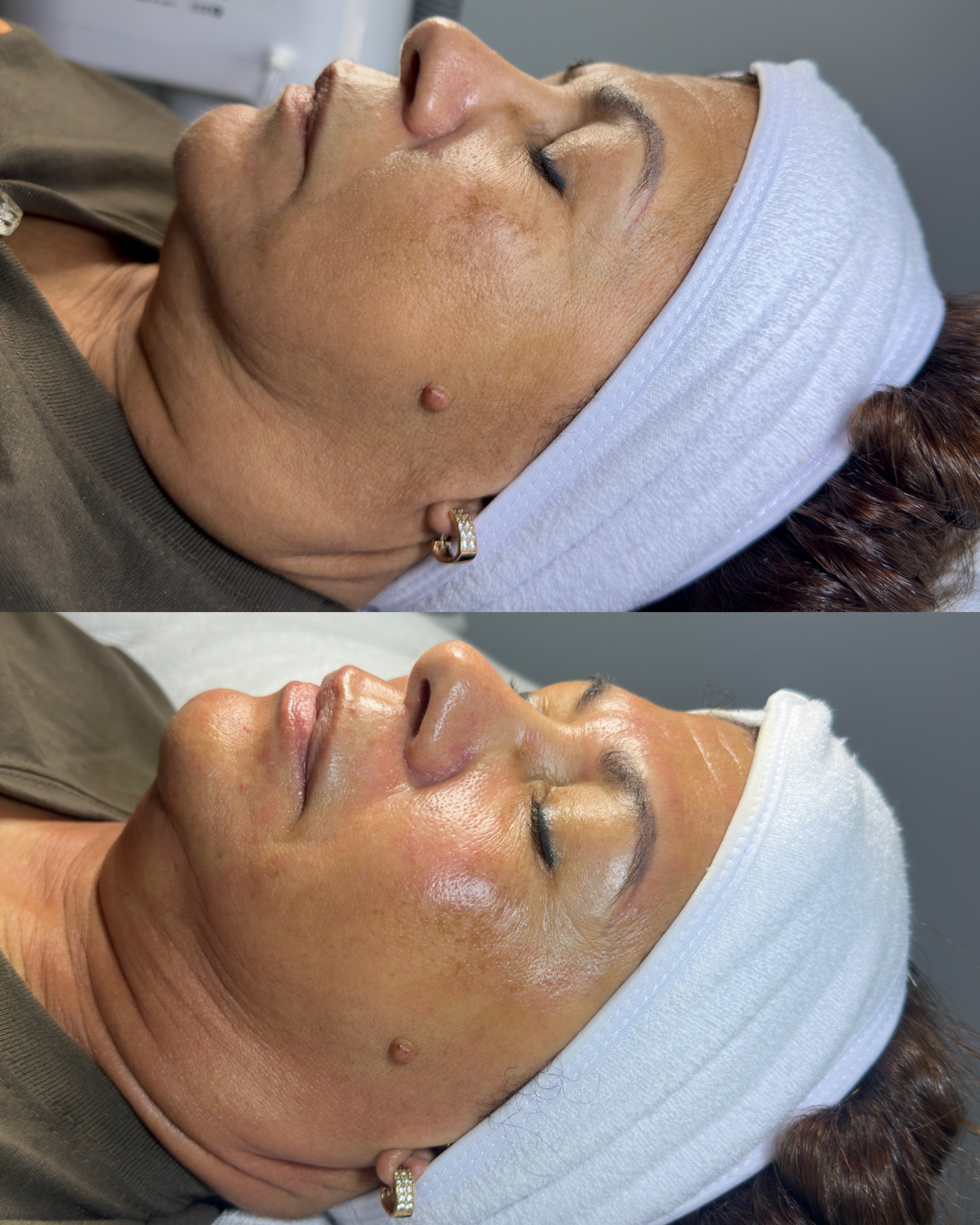 Mature skin rejuvenation facial before and after — Skin Care by Rejuvenate Wellness