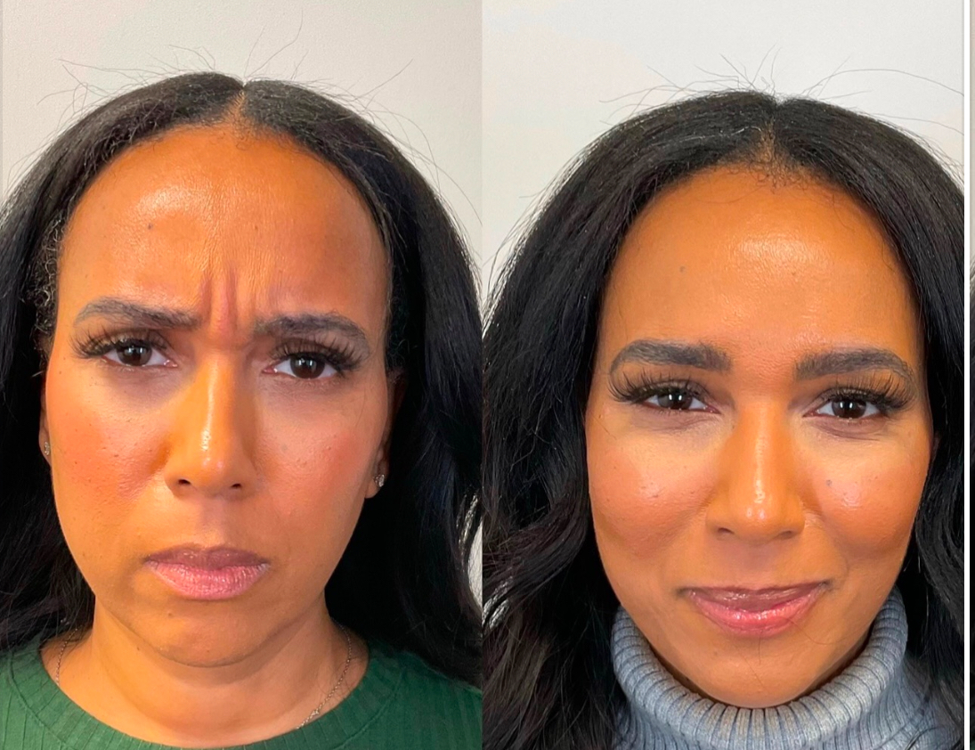 After — Frown Lines Eliminated