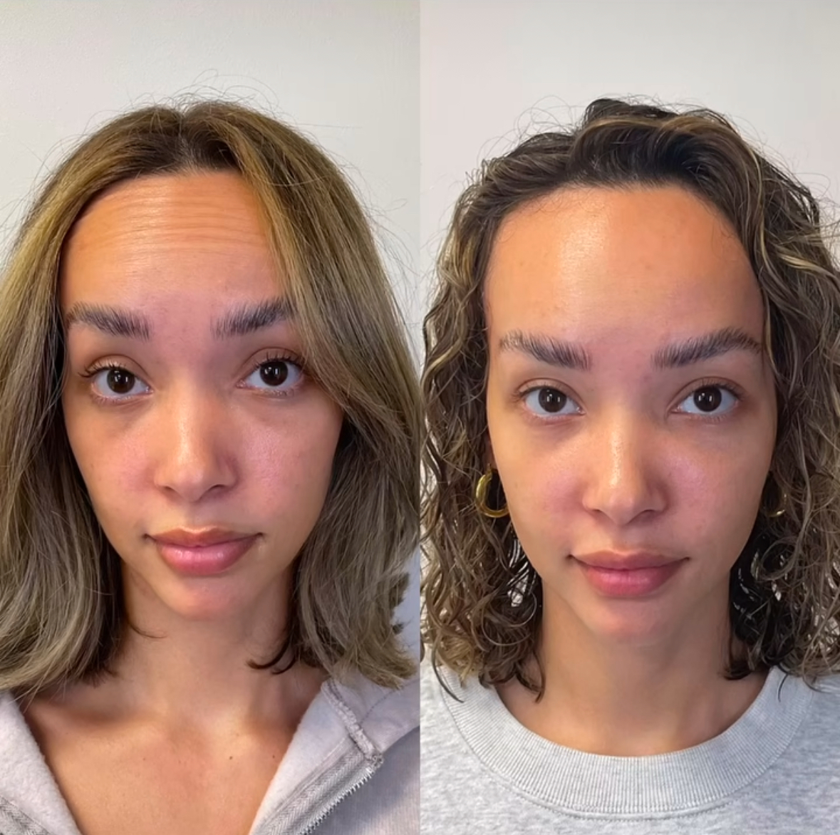 Botox before and after β dramatic forehead and frown line correction, male client