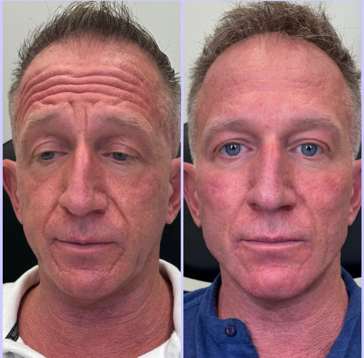 Before — Forehead Smoothing