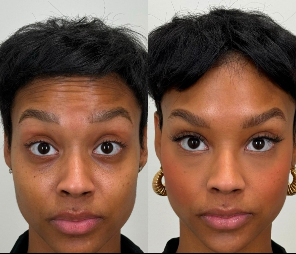 After — Lines Gone. Expression Preserved.