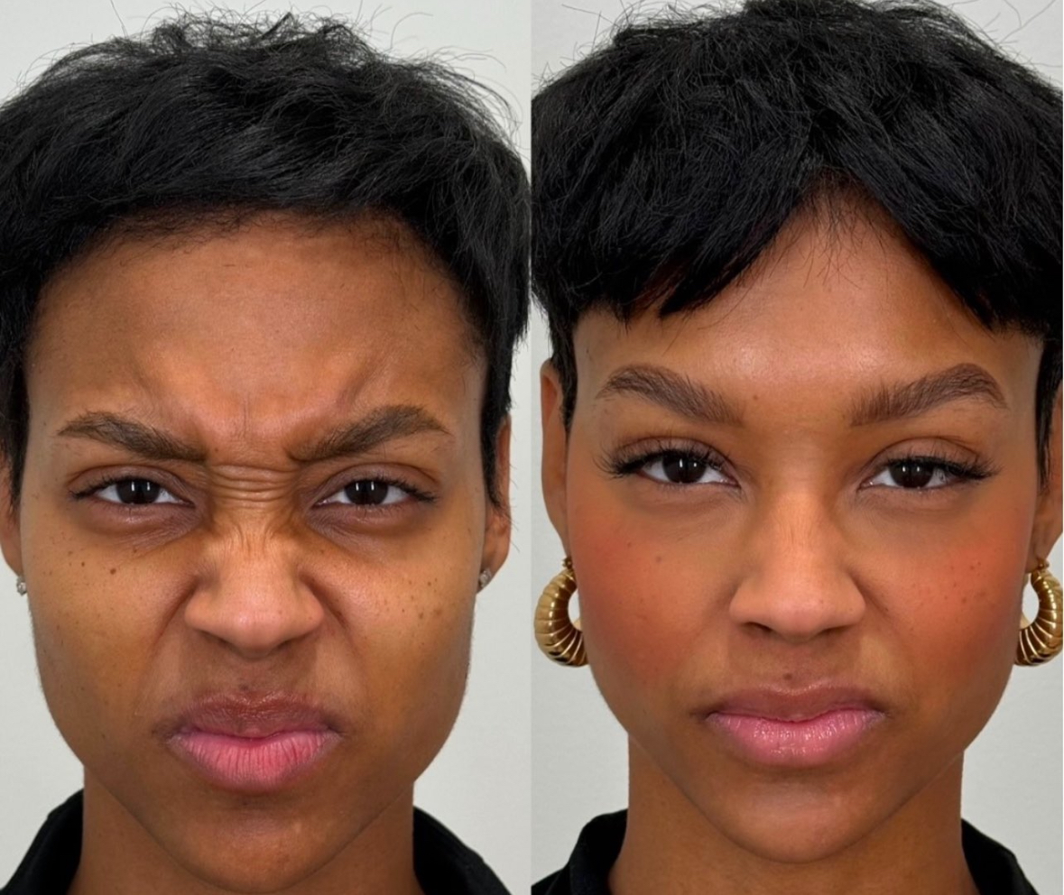 Before — Forehead + Frown Lines
