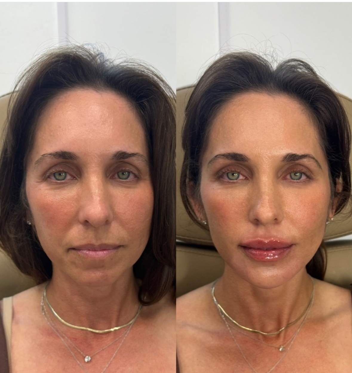 After — Volume. Contour. Lifted.