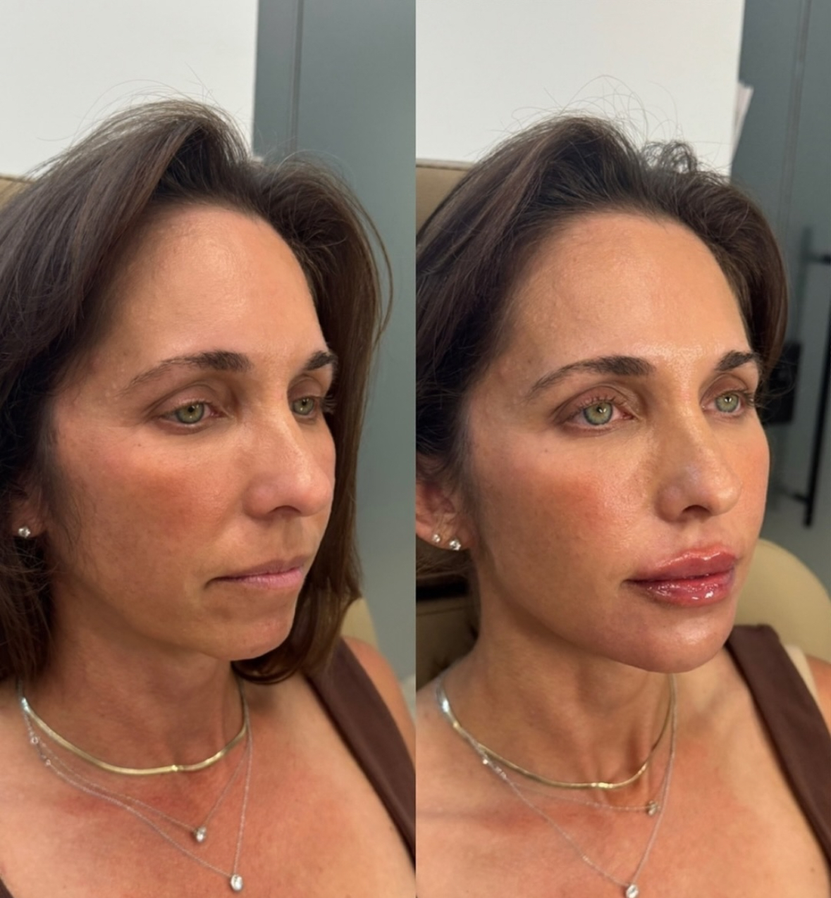 Before — Cheek & Lip Filler