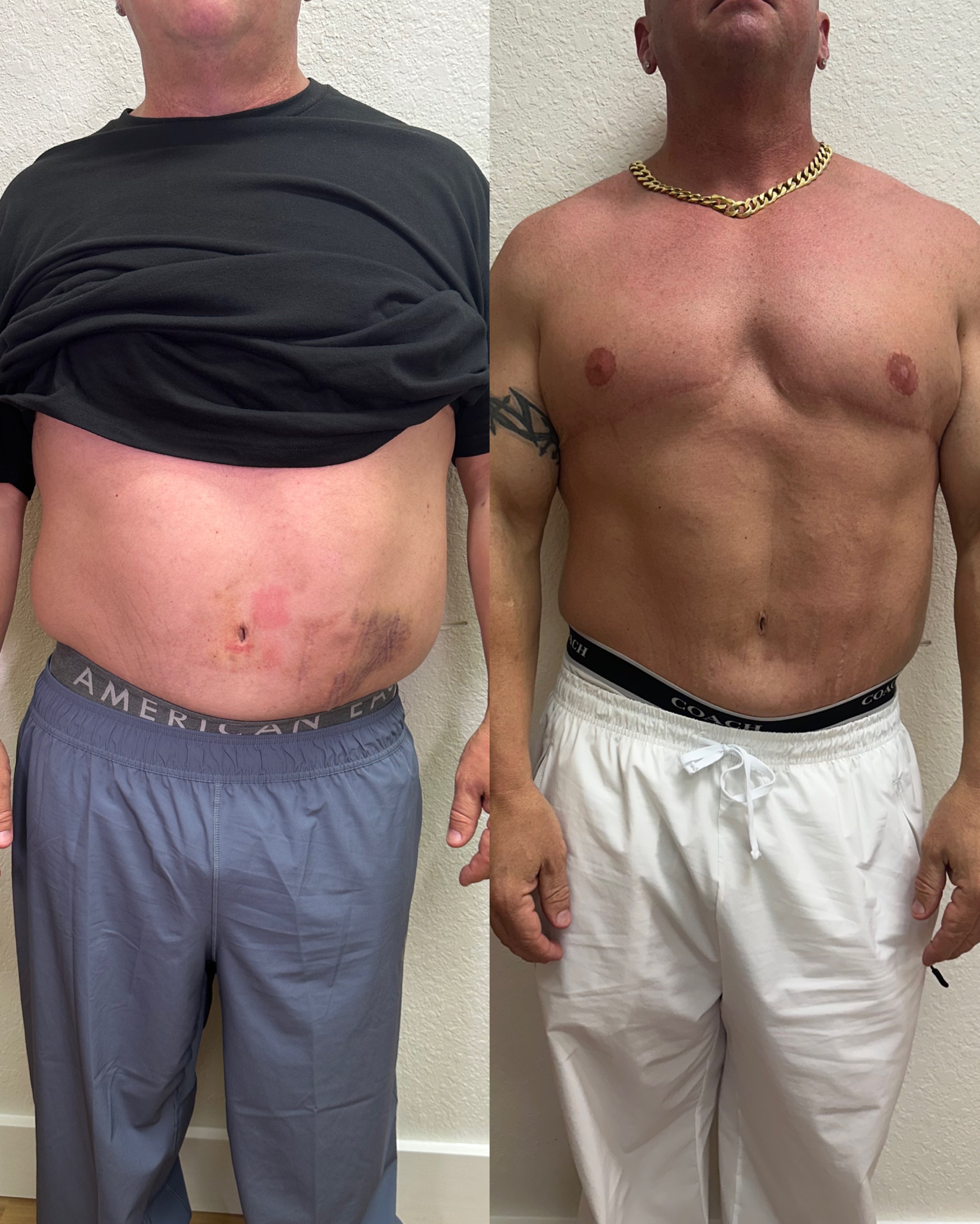 Male body contouring before and after — front view