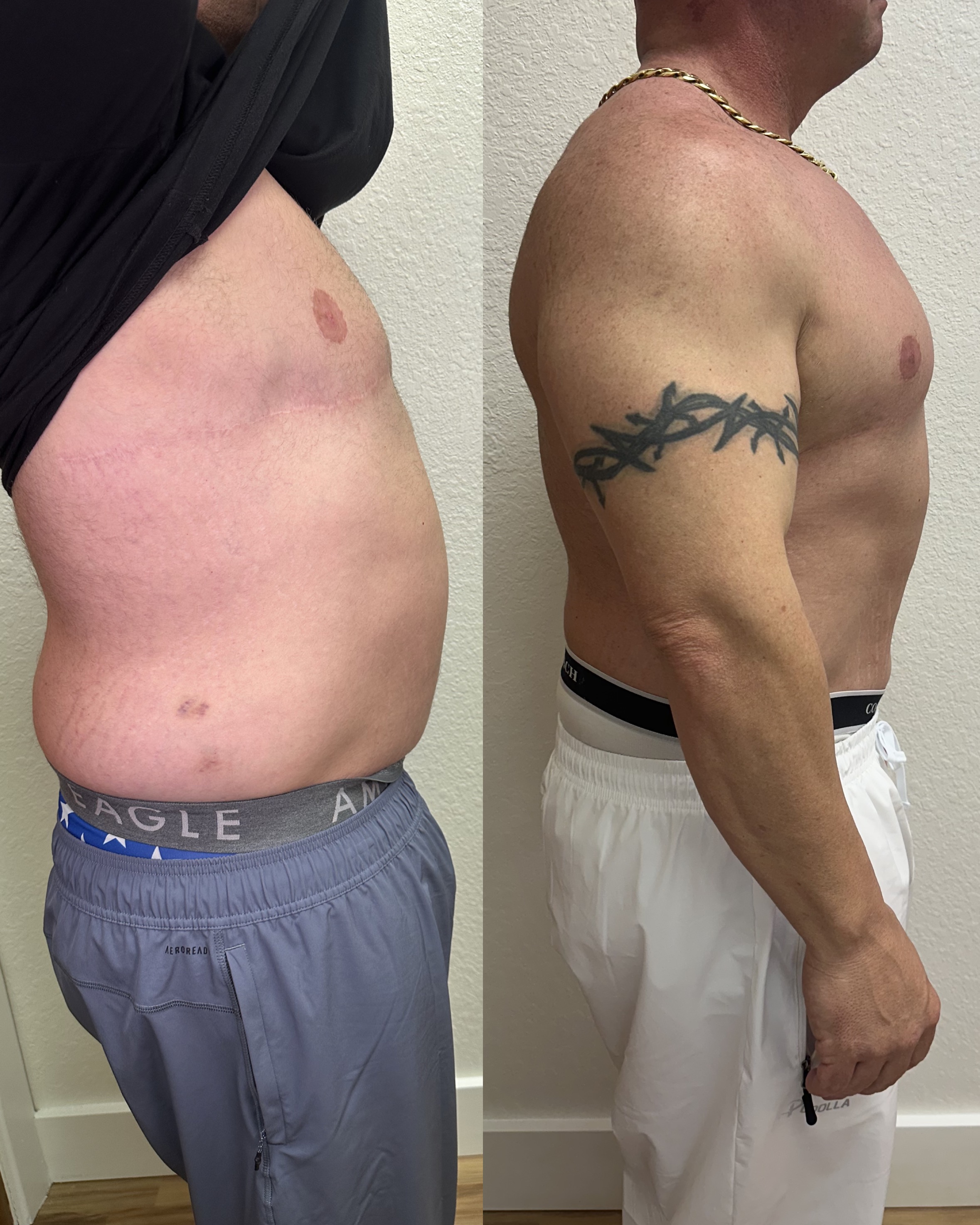 Male body contouring before and after — side profile