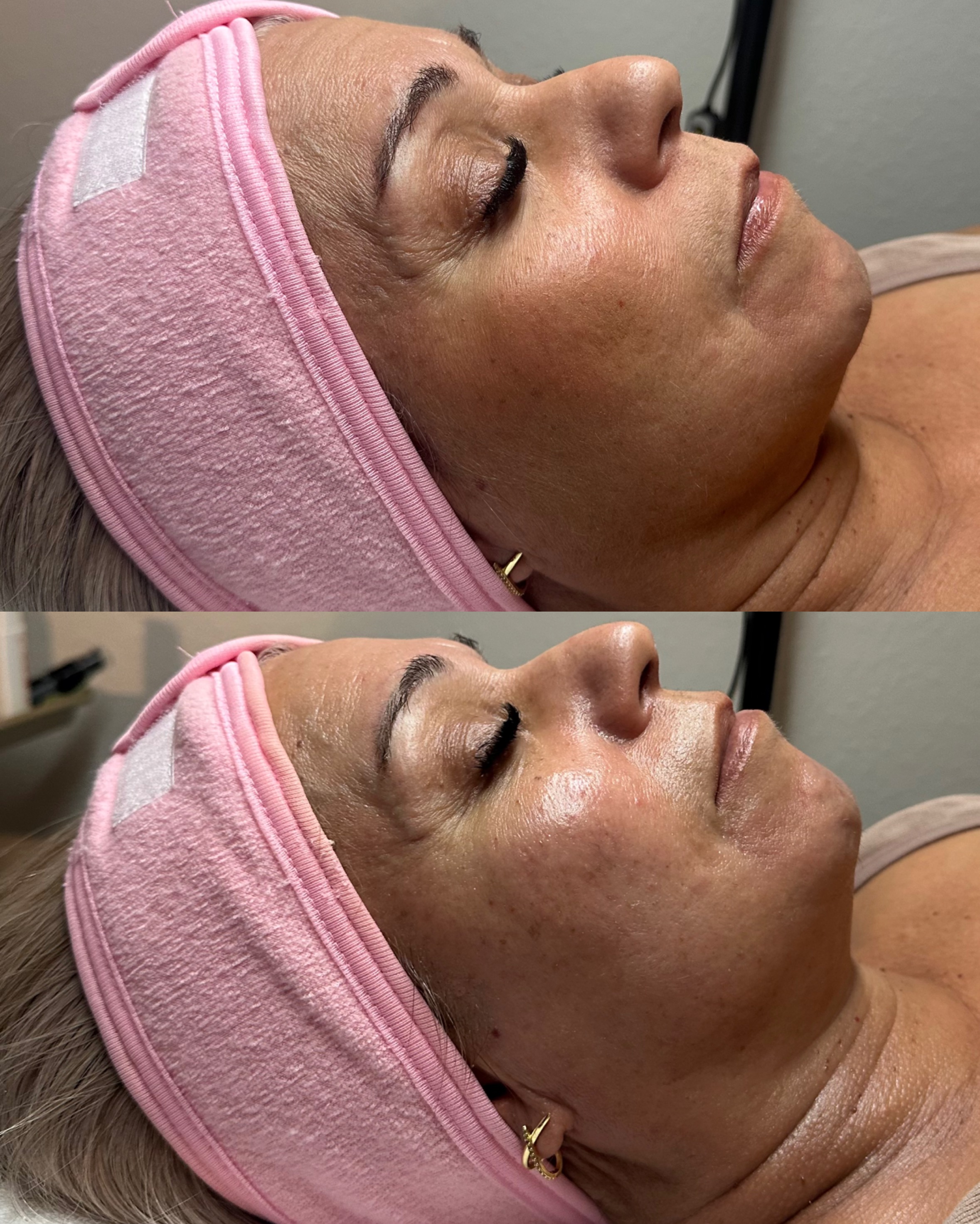 Skin brightening and hydration facial results — before and after at Skin Care by Rejuvenate Wellness