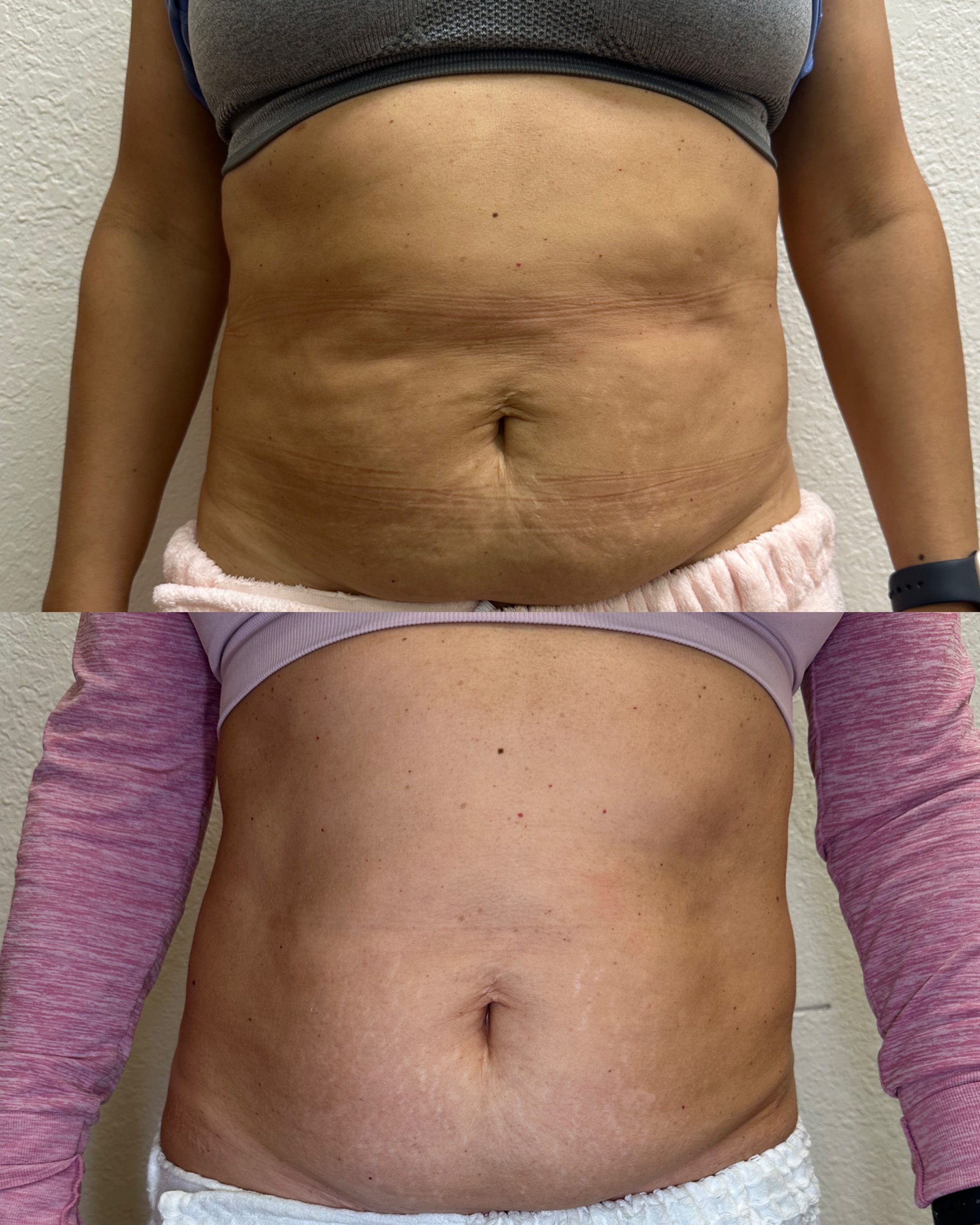 Female body contouring before and after — abdomen