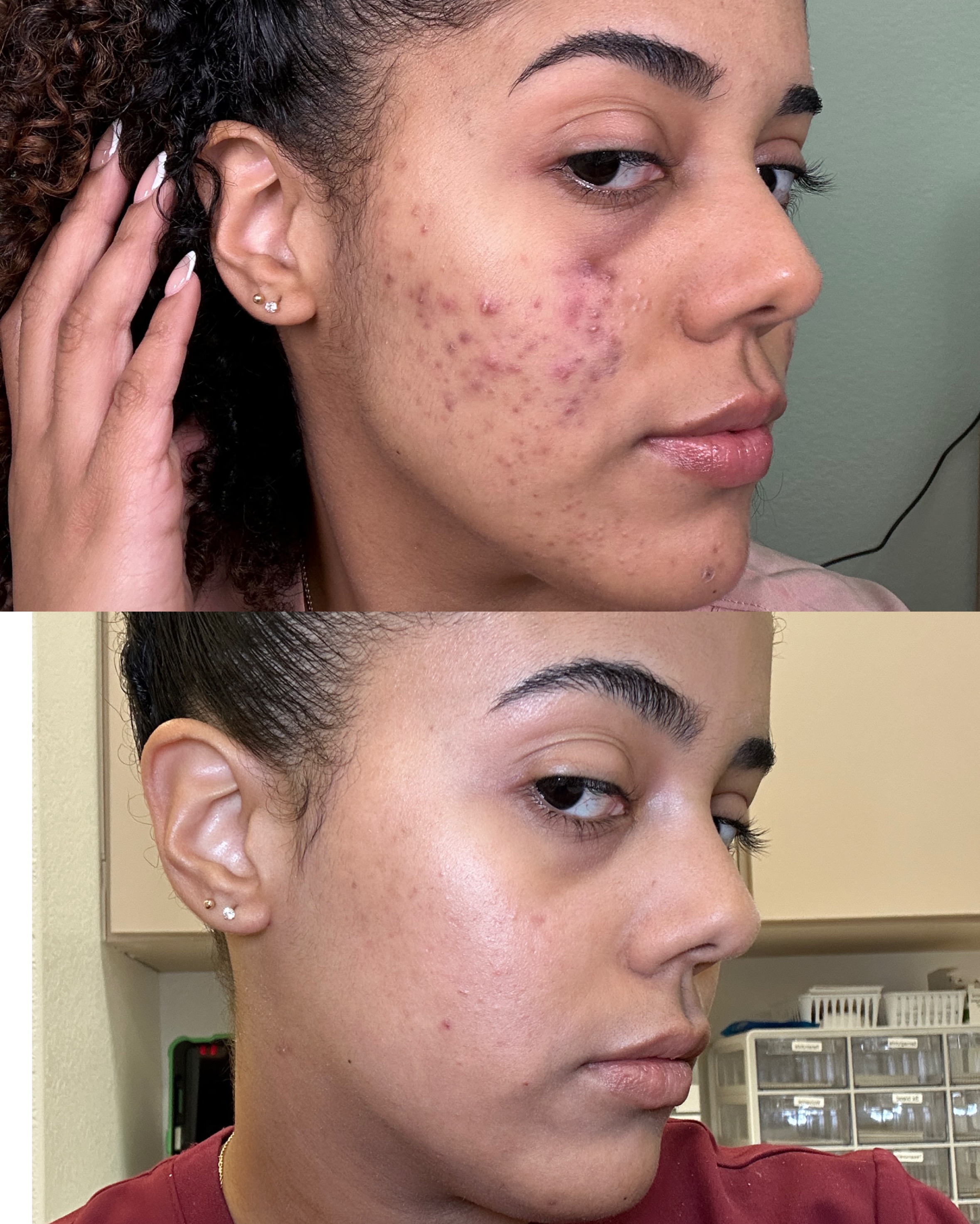 Acne clearing facial results — before and after at Skin Care by Rejuvenate Wellness