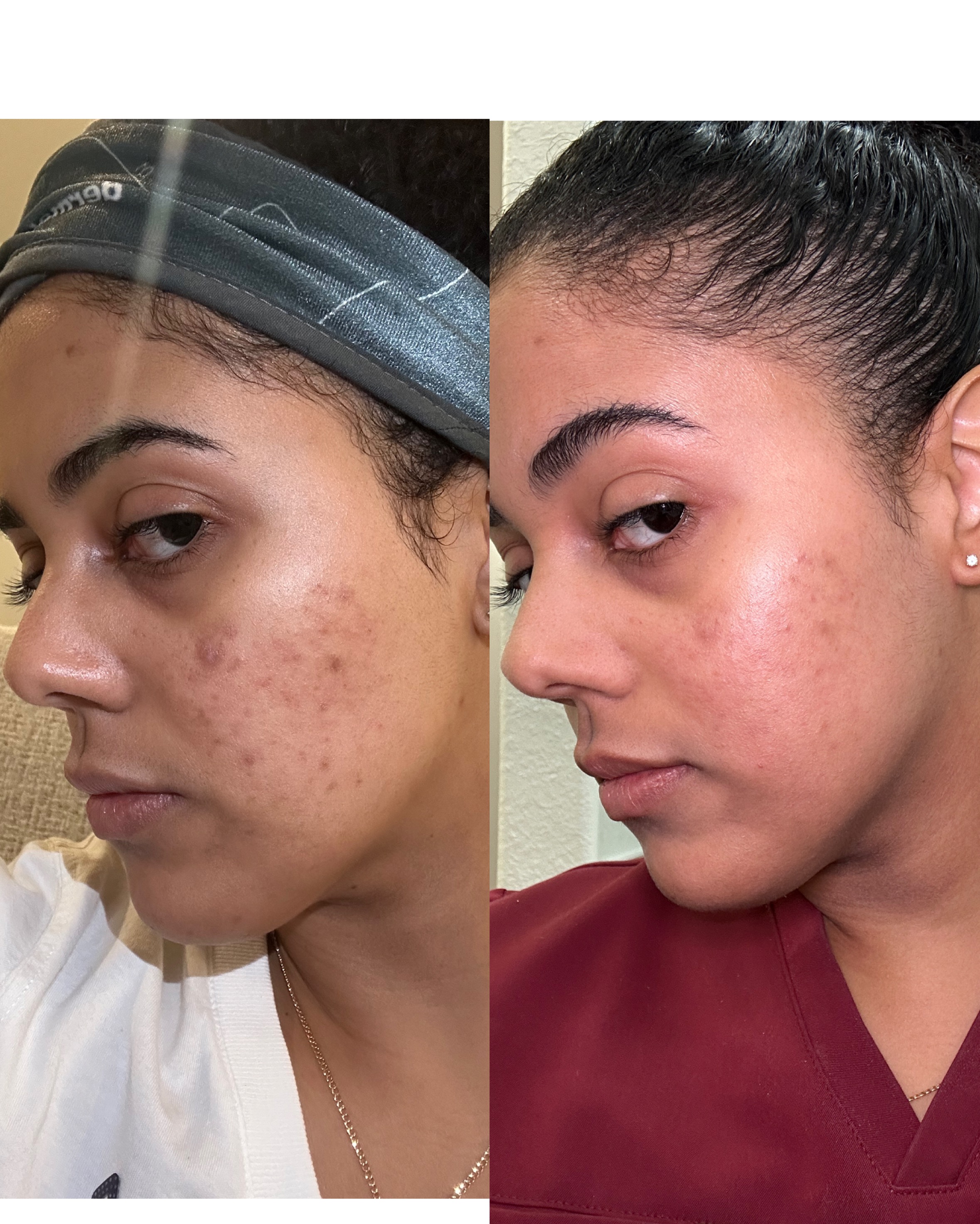 Acne and dark spots treatment before and after — Skin Care by Rejuvenate Wellness