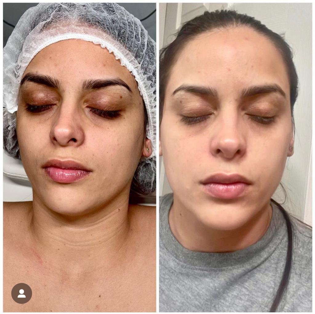 microneedling images